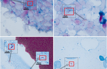 Mesterséges intelligencia segíti a tuberkulózis felismerését
